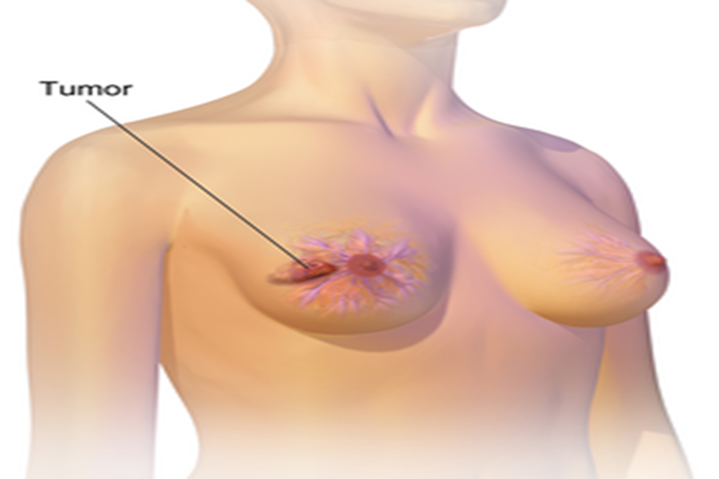 Fibromialgia